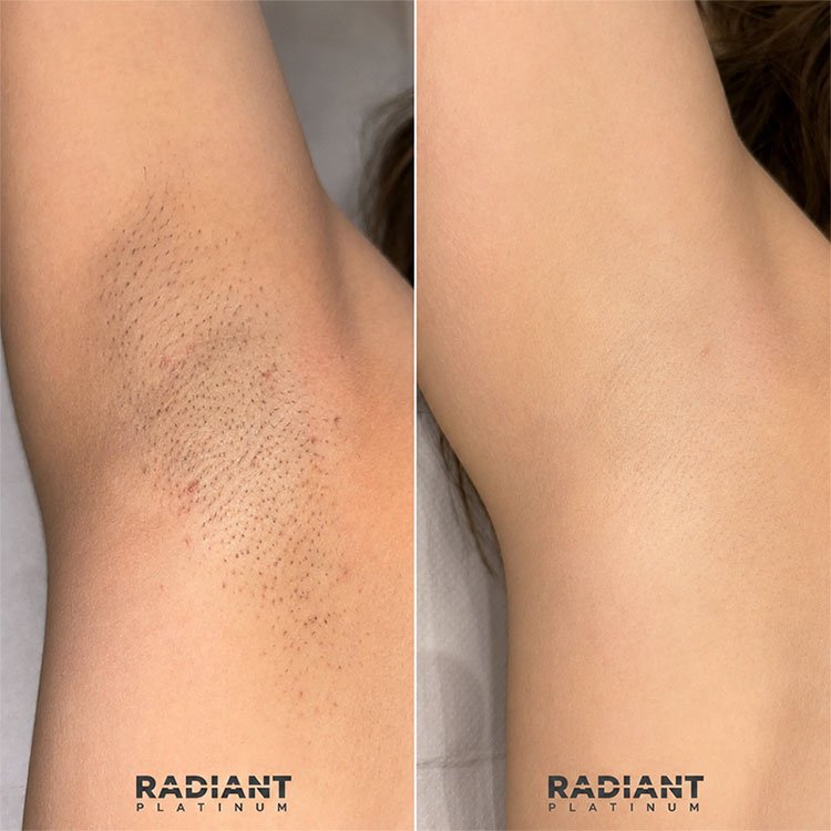 Radiant Platinum Diode Laser