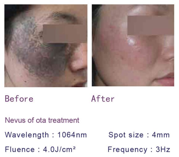 Radiant Spectra ND YAG Laser