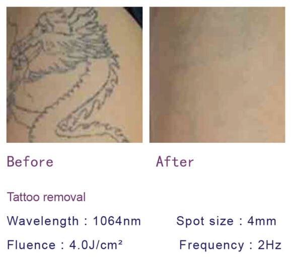 Radiant Spectra ND YAG Laser